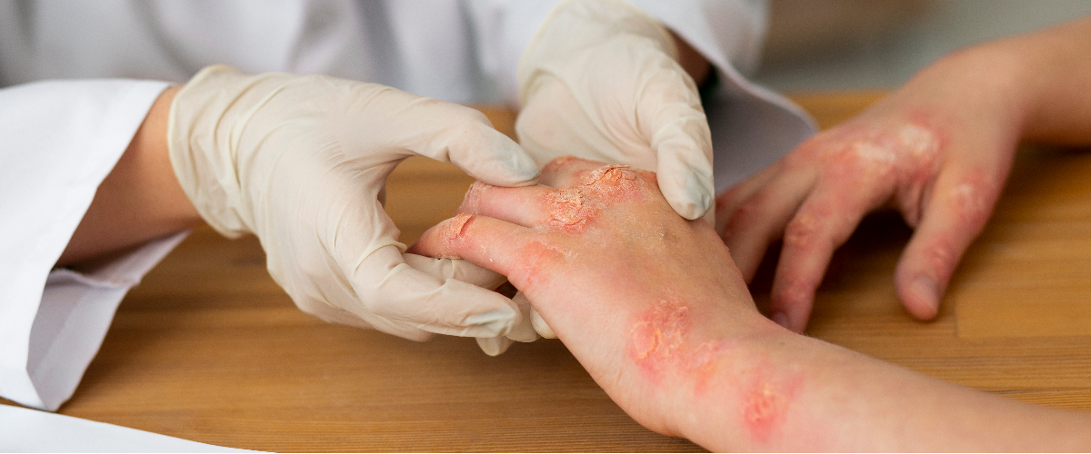 الأمراض الجلدية والتناسلية (الأمراض الجلدية)